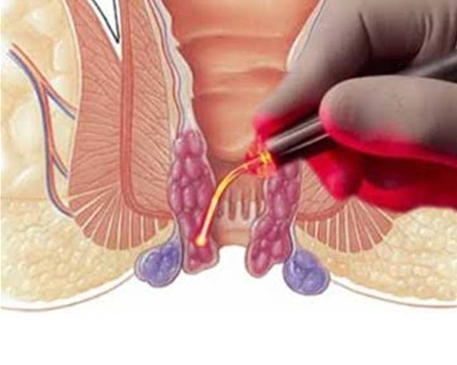 Laser Treatment