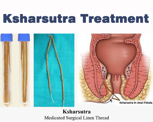 Ksharsutra Treatment