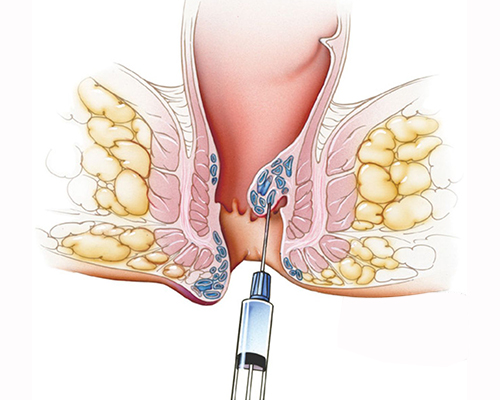 Injection Treatment