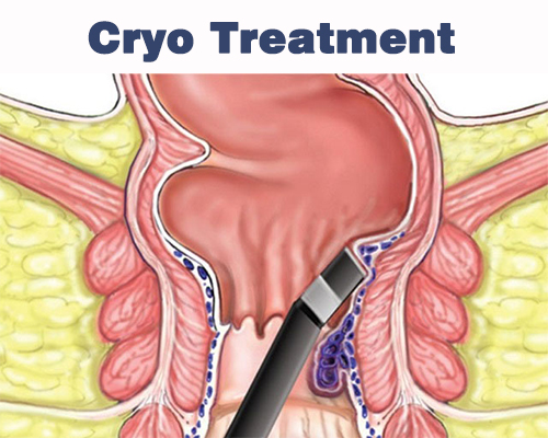 Cryo Treatment