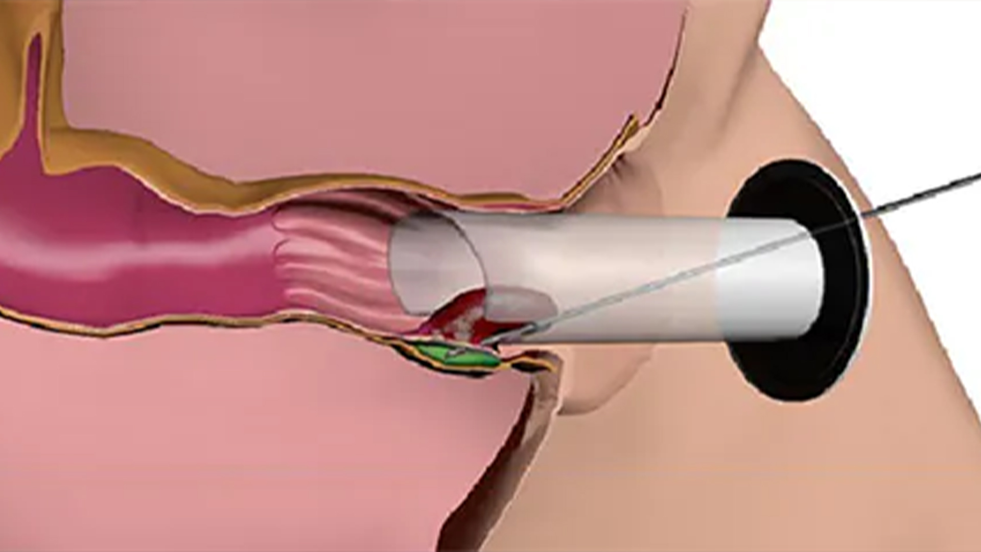 Radio Frequency Treatment