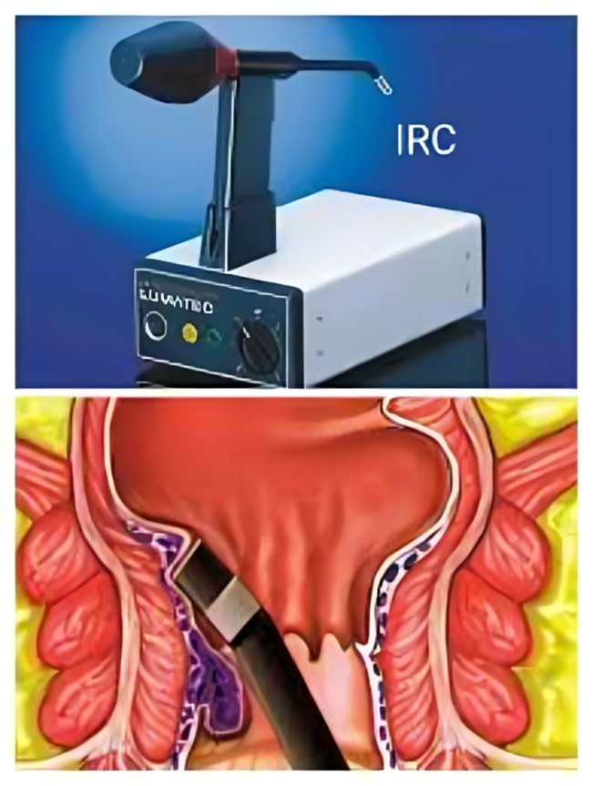 I.R.C. Treatment